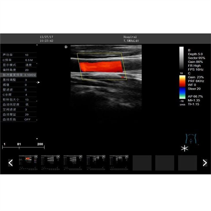 Trolley Color Doppler Ultrasound Machine